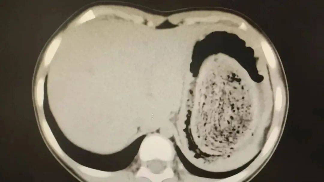 皇冠信用网登2_发现1例皇冠信用网登2,15岁女孩确诊!