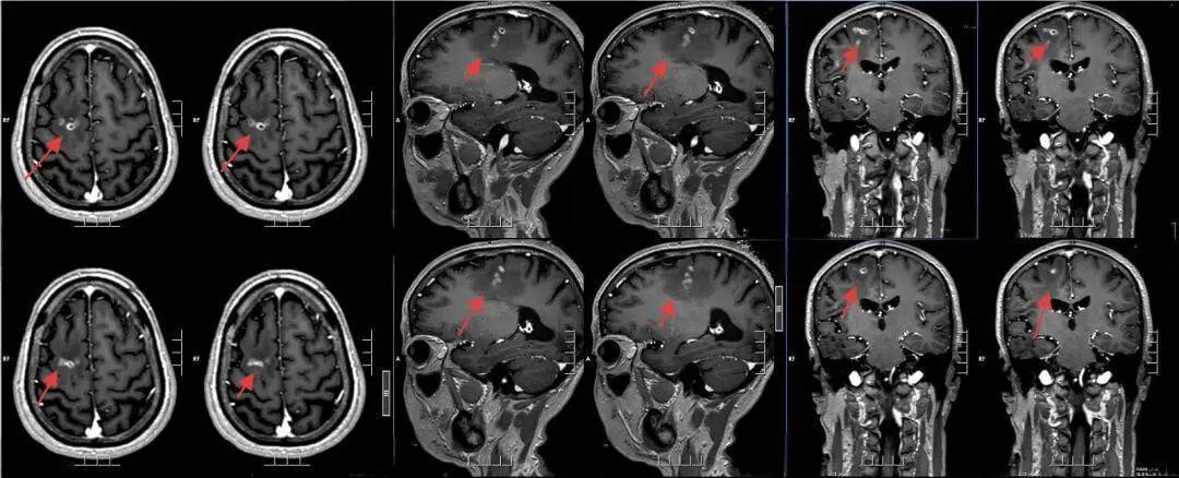 怎么申请皇冠信用网
_广东一男子20多年不敢一个人出门怎么申请皇冠信用网
，医生从他脑中取出10厘米活虫